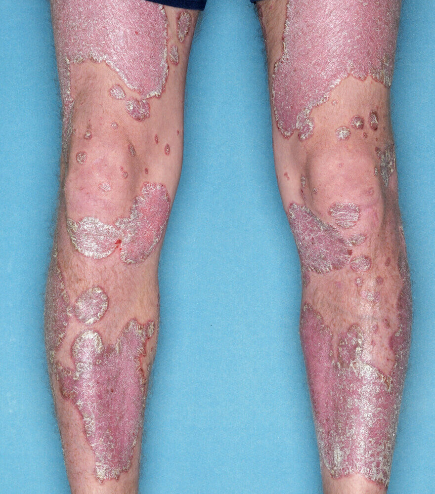 Psoriasis patient photos 15% BSA before vs 0% BSA after 3 months with SILIQ